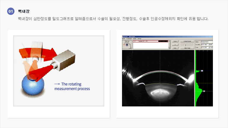 백내장, 백내장이 심한정도를 밀도그래프로 알려줌으로서 수술의 필요성, 진행정도, 수술후 인공수정체위치 확인에 유용합니다. (첨부) 검사결과 이미지