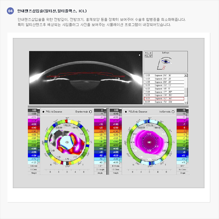 안내렌즈삽입술(알티산,알티플렉스,ICL), 안내렌즈삽입술을 위한 전방깊이, 전방크기, 홍채모양 등을 정확히 보여주어 수술후 합병증을 최소화해줍니다. 특히 알티산렌즈후 예상되는 샤임플러그 사진을 보여주는 시뮬레이션 프로그램이 내장되어있습니다. (첨부) 검사결과 이미지