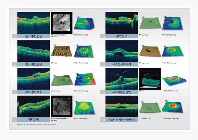 CIRRUS OCT 검사로 발견된 망막의 변형 이미지