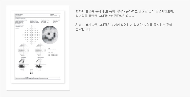 치료가 불가능한 녹내장은 조기에 발견하여 최대한 시력을 유지하는 것이 중요합니다.